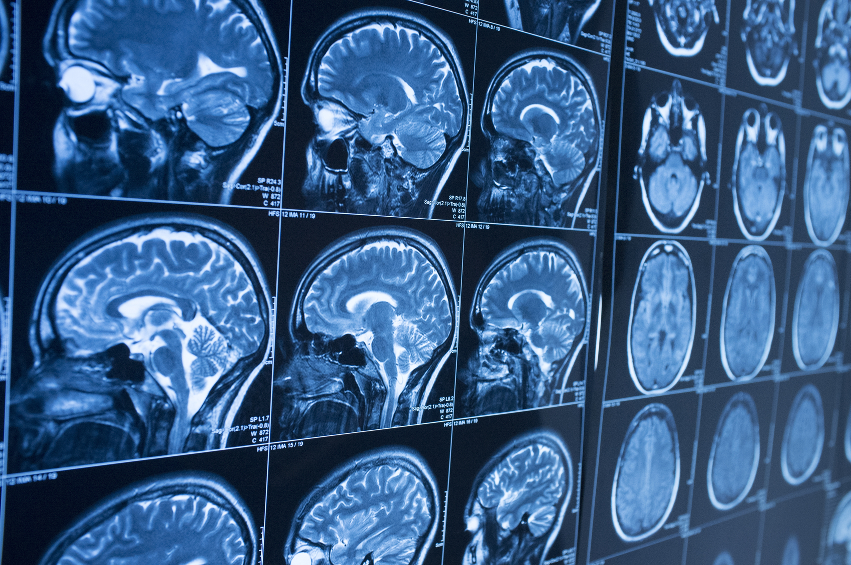 What Is CTE?