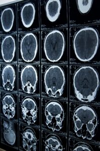 brain injury lawyer in St. George, LA